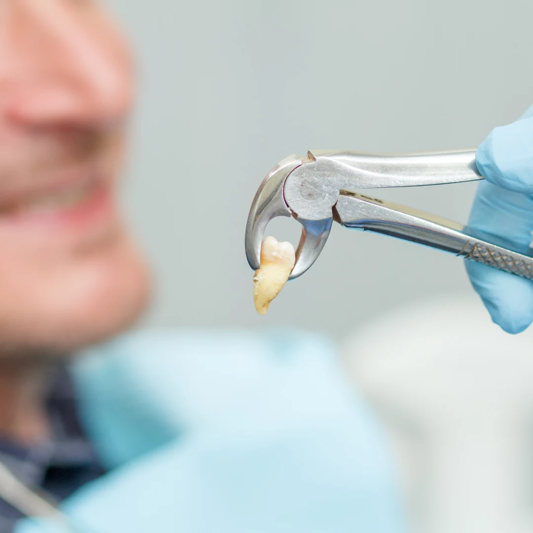 Wisdom Tooth Extraction